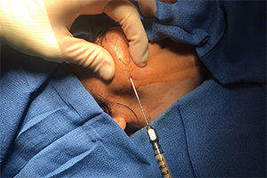 An injection of autologous fat, shown here, can bring many advantages to the aging face.