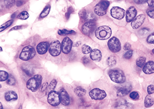 Histopatholgical image of papillary carcinoma of the thyroid gland