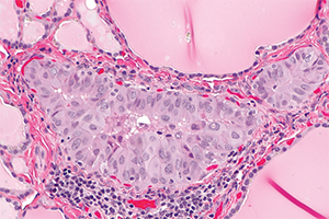 Micrograph of a papillary thyroid microcarcinoma