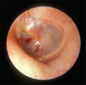 Traumatic perforation of the tympanic membrane.