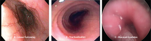 Common endoscopic abnormalities seen in patients with eosinophilic esophagitis. Credit: Copyright 2017 The American Laryngological, Rhinological and Otological Society, Inc.