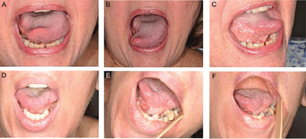 Figure 1. Granulation postoperatively. (A–C) Patient six months after partial glossectomy involving one-third of the tongue and small area of lateral floor of mouth. (D–F) Patient 15 months after partial glossectomy involving one-third of the tongue and lateral floor of mouth. Note adequate tongue protrusion with only mild tethering in both patients Credit: Copyright 2017 The American Laryngological, Rhinological and Otological Society, Inc.