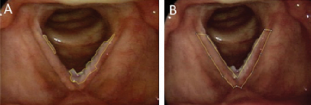 Figure 2. Determination of % lesion regression. (A) Average lesion area (three measurements) = 1,831 pixels. (B) Average full VF area (three measurements) = 6,924 pixels. Percent VF covered by the lesion was determined by (A/B) × 100% = (1,831/6,924) × 100% = 26.4% of the VF covered by lesion. This % was then compared with the postoperative picture % to determine regression. Credit: Copyright 2017 The American Laryngological, Rhinological and Otological Society, Inc.