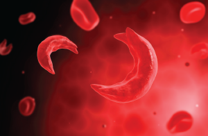 Sickle cells
