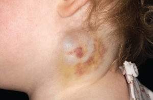 Cystic hygroma.