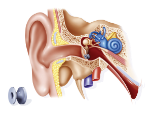 Ventilation tube set up in the ear at the level of the tympanic membrane to improve aeration of the middle ear to treat acute otitis.