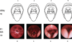 Comparison of Brodsky physical exam score and representative images of Chan-Parikh scoring for lateral pharyngeal wall domain Credit: Copyright 2017 The American Laryngological, Rhinological and Otological Society, Inc.