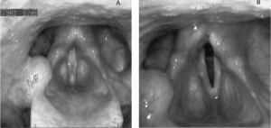 Effects of the continuous LP system stimulation during and in absence of phonation. (A) Aligned vocal folds during phonation of the vowel [eee]. The position of both arytenoid cartilages is symmetric and the vocal folds show the same length and tension. The adduction required to phonate overrides the abduction elicited by the LP system. (B) Abduction of the right vocal fold caused by electrical posterior cricoarytenoid muscle stimulation via the LP system in absence of phonation. The right arytenoid cartilage shows dorsolateral shifting, whereas the vocal fold is driven into a position that can be classified between paramedian and intermedial. Accordingly, the stimulation mediated by the LP system results in the formation of a clearly visible glottal gap of about 3 to 4 mm. Credit: Copyright 2017 The American Laryngological, Rhinological and Otological Society, Inc.