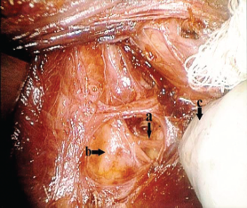 Intraoperative view of a right nonrecurrent laryngeal nerve as captured during right thyroidectomy in one of our cases. (A) Right nonrecurrent laryngeal nerve. (B) Right common carotid artery. (C) Retracted right thyroid lobe. Credit: © The American Laryngological, Rhinological and Otological Society, Inc.