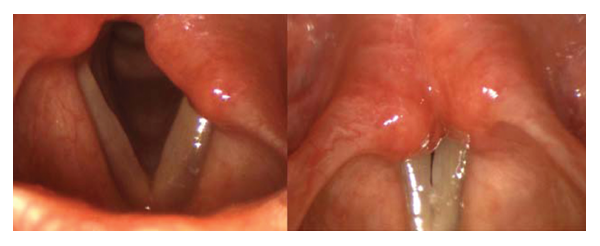 The vocal folds in abduction and during phonatory adduction on rigid strobolaryngoscopic examination. Most examiners found a left-sided (97%) paresis involving the recurrent laryngeal nerve (74%). Examiners indicated decreased VF abduction, slow/sluggish VF movement, and decreased VF adduction as the most compelling clinical findings in diagnosis. Credit: © The American Laryngological, Rhinological and Otological Society, Inc.