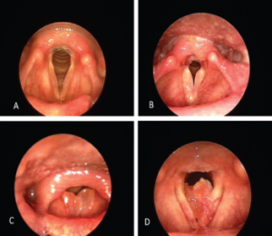 Clinical photographs of graded Reinke’s edema lesions. (A) Grade 1 lesions bilaterally with minimal polypoid degeneration. (B) Grade 2 bilateral lesions with expanded polypoid lesion occupying 25% to 50% of the glottic airway. (C) Grade 3 bilateral lesions occupying at least 50% of the glottic airway. (D) Grade 4 obstructive lesion. © The American Laryngological, Rhinological and Otological Society, Inc.