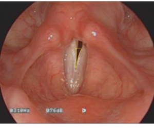 Calculation of anterior glottic gap area in pixels using Image J software. Anterior gap is traced out in yellow and pixels within the lines are calculated. Normalized gap is then calculated by dividing anterior gap by the square of vocal fold length times 100. © The American Laryngological, Rhinological and Otological Society, Inc