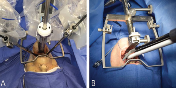 Comparison of bedside setup for robotic tongue base resection. Patient bedside setup of the flexible, single-port da Vinci Sp robotic surgical system (A) and the rigid, multiarm da Vinci Si robotic surgical system (B). The camera is positioned below in the da Vinci Sp’s cannula. The Sp system offers more space for the bedside surgical assistant. © 2017 The American Laryngological, Rhinological and Otological Society, Inc.