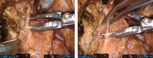 Isolation of small branching vessels with da Vinci Sp dual-forceps dissection. (A) The Maryland forceps (left) are providing traction and the fenestrated bipolar forceps (right) are being used to isolate a small branching vessel within the deep tongue musculature. The cautery spatula (top) is being used as a blunt retractor to provide slight counter traction. (B) The vessel has been isolated and is being controlled with surgical clips that are placed by the bedside assistant. © 2017 The American Laryngological, Rhinological and Otological Society, Inc.