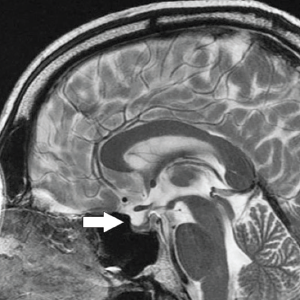 Midsagittal, T2-weighted MRI demonstrating compression of the pituitary gland (arrow) in a patient with idiopathic intracranial hypertension. This qualifies as a positive empty sella sign.