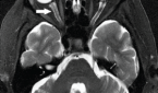 Axial, T2-weighted MRI demonstrating optic nerve sheath dilation (white arrow) and flattening of the posterior aspect of the right globe (asterisk).