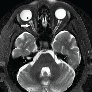 Axial, T2-weighted MRI demonstrating optic nerve sheath dilation (white arrow) and flattening of the posterior aspect of the right globe (asterisk).