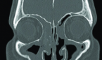 Coronal CT scan of CRSwNP showing extensive polyposis lining the bilateral maxillary, ethmoid, and frontal sinuses
