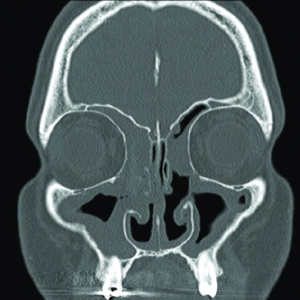 Coronal CT scan of CRSwNP showing extensive polyposis lining the bilateral maxillary, ethmoid, and frontal sinuses