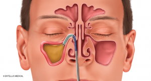 First Clinical Consensus Statement on Balloon Dilation Aims to Ensure Patient Safety