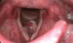 Right vocal fold polyp