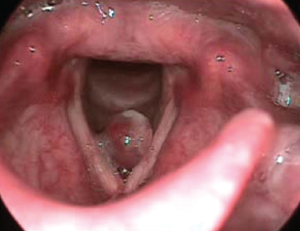 Right vocal fold polyp