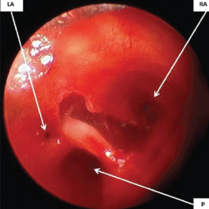 Rigid bronchoscopic view of the laryngotracheo-oesophageal cleft showing three openings: Right anterior (RA), left anterior (LA) and posterior (P).