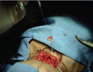 Single-stage laryngotracheal reconstruction