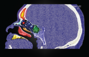 Sinus osteoma.