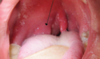 Right-sided peritonsilar abscess.