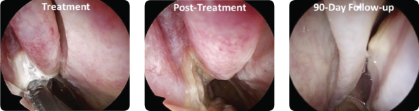 Endoscopic images from a patient at (A) treatment, (B) immediately posttreatment, and (C) 90-day follow-up.