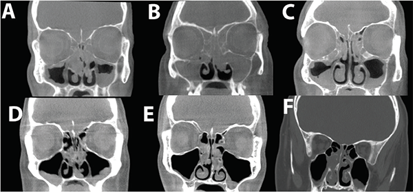 Radiological characteristic of eCRS and CCAD. Representative CT scan images of eCRS, with complete opacification of ethmoids and diffuse mucosal involvement of the maxillary sinuses (A–C). This is in contrast to CCAD where there is a central focus of the mucosal disease due to middle turbinate polyposis. If the sinuses are involved, the roof or lateral wall tends to be relatively normal (D–F). Credit: © 2018 The American Laryngological, Rhinological and Otological Society, Inc.