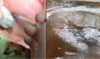 Botulinum toxin A injection into the right submandibular gland under ultrasound guidance. Positioning of the ultrasound probe in the submandibular region (left) and ultrasound image of the Botox injection with the black arrows highlighting the tract of the needle as it enters the submandibular gland (right).
