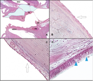 Histological analysis of the middle ear space. (A) Slide from a left ear, at the level of the pars flaccida, showing the space where the ciliated cells were counted at the epitympanum: lateral side of the malleus and incus, and medial side of the lateral wall. The light blue area represents the area where the ciliated cells were counted (H&E, 1 × magnification). (B) The arrow shows the flat epithelium located at the lateral side of the malleus (H&E, 10 × magnification). (C) The arrow shows the flat epithelium located at the medial side of the lateral wall at the epitympanum (H&E, 10 × magnification). (D) Histological view of the respiratory-like epithelium that covers the lateral wall of the protympanum toward the Eustachian tube. The arrowheads show the goblet cells located at this space (H&E, 40 × magnification). CP = cochleariform process; EAC = external auditory canal; FN = facial nerve; H&E = hematoxylin and eosin; HSCC = horizontal semicircular canal; I = incus; M = malleus; TM = tympanic membrane. Credit: © 2018 The American Laryngological, Rhinological and Otological Society, Inc.