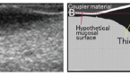 Example of sonographic visualization of oral tongue squamous cell carcinoma. Tumor is identified as a hypoechoic area on ultrasound. (B) Schematic representation of the difference between TT and DOI. © Reprinted from Oral Surg Oral Med Oral Pathol Oral Radiol, 119(2):246–253, Copyright 2015, with permission from Elsevier.