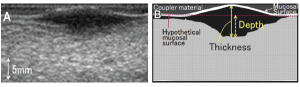 Example of sonographic visualization of oral tongue squamous cell carcinoma. Tumor is identified as a hypoechoic area on ultrasound. (B) Schematic representation of the difference between TT and DOI. © Reprinted from Oral Surg Oral Med Oral Pathol Oral Radiol, 119(2):246–253, Copyright 2015, with permission from Elsevier.