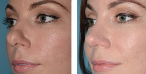 Before (left) and after (right) photos demonstrating functional and cosmetic improvement after lateral crural tensioning.