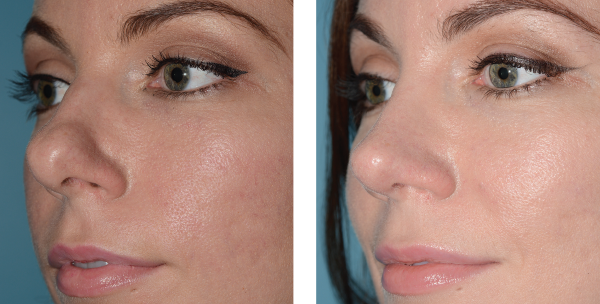 Before (left) and after (right) photos demonstrating functional and cosmetic improvement after lateral crural tensioning.
