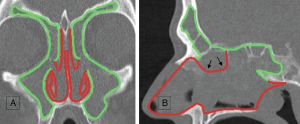 Green lines show the mucosal areas removed during the reboot surgery; red lines show the mucosal areas that are kept untouched. (A) Coronal view. Notice the untouched parts of middle turbinates kept as important suppliers for epithelial regrowth and surgical landmarks. (B) Sagittal view (black arrows point to the septal area that is removed during Draf III procedure). © 2019 The American Laryngological, Rhinological and Otological Society, Inc.