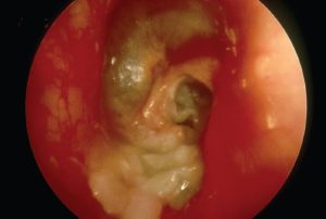 Otoscopic view of myringitis. Dr. Livingstone used a database of otoscopic images to train his algorithm to diagnose 14 otologic conditions.