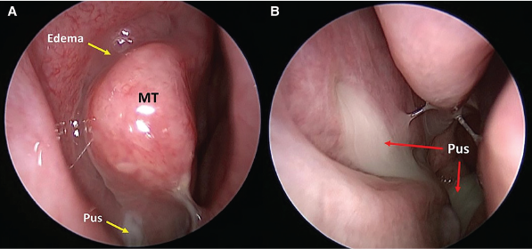 Primary Endoscopic Surgery Led To Faster Resolution Of Sinusitis Symptoms Than Dental Treatments Enttoday