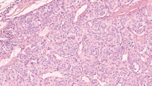 Photomicrograph of a paraganglioma.