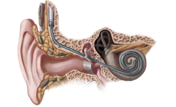 Intracochlear Fibrosis Following CI Significantly Limits Cochlear Implant Success