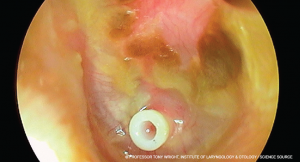 © PROFESSOR TONY WRIGHT, INSTITUTE OF LARYNGOLOGY & OTOLOGY / Science Source
