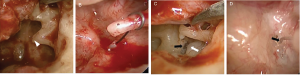 Fig. 1. Intraoperative findings. (A) Necrosis of long process of incus (arrowhead) resulting in prosthesis displacement from stapes footplate (*) (patient 2). (B) Prosthesis displaced to posterior rim of footplate (*) (patient 1). (C) Prosthesis displacement (removed) with prolapsed facial nerve (white arrow) and prominent bony overhang (black arrow), which was drilled to allow for prosthesis placement during revision surgery (patient 3). (D) Short wire loop prosthesis (black arrow) making poor contact with stapes footplate (*) (patient 4).