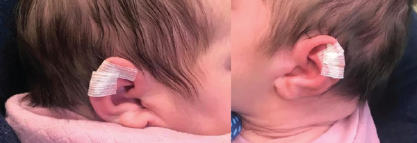 How to: Neonatal Ear Molding - ENTtoday