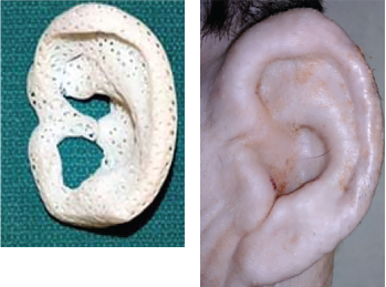 Fig. 2. Images of a 3D-printed ear, and the ear after implantation.