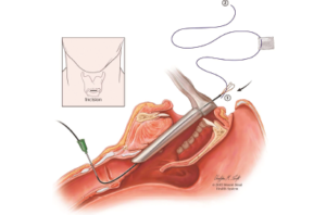 Fig. 1. Passing an intravenous catheter through a 1-cm skin incision over the cricothyroid membrane into the subglottis and retrieving the inferior suture end using the renal stone extractor