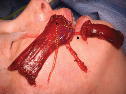 Fig. 1. Intraoperative photograph of harvested ipsilateral flap demonstrating orientation of upper and lower lip paddles following 180° in-plane rotation. In this iteration, the nerve and vascular pedicle are reflected deep to the flap for coaptation with the ipsilateral nerve-to-masseter muscle and anastomosis with the facial vessels. The approximate location of the hilum (h) and course of the neurovascular pedicle (dotted lines: yellow—nerve-to-gracilis muscle, blue—venae comitans, red—artery) on the deep aspect of the flap is demonstrated, together with the continuation of the neurovascular pedicle (arrowhead) to the lower lip paddle.