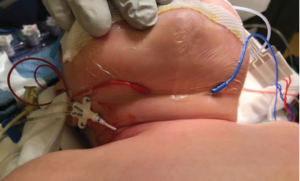 Fig. 1. Electrode needles of additional active leads are placed into the neck close to the thyroid cartilage.